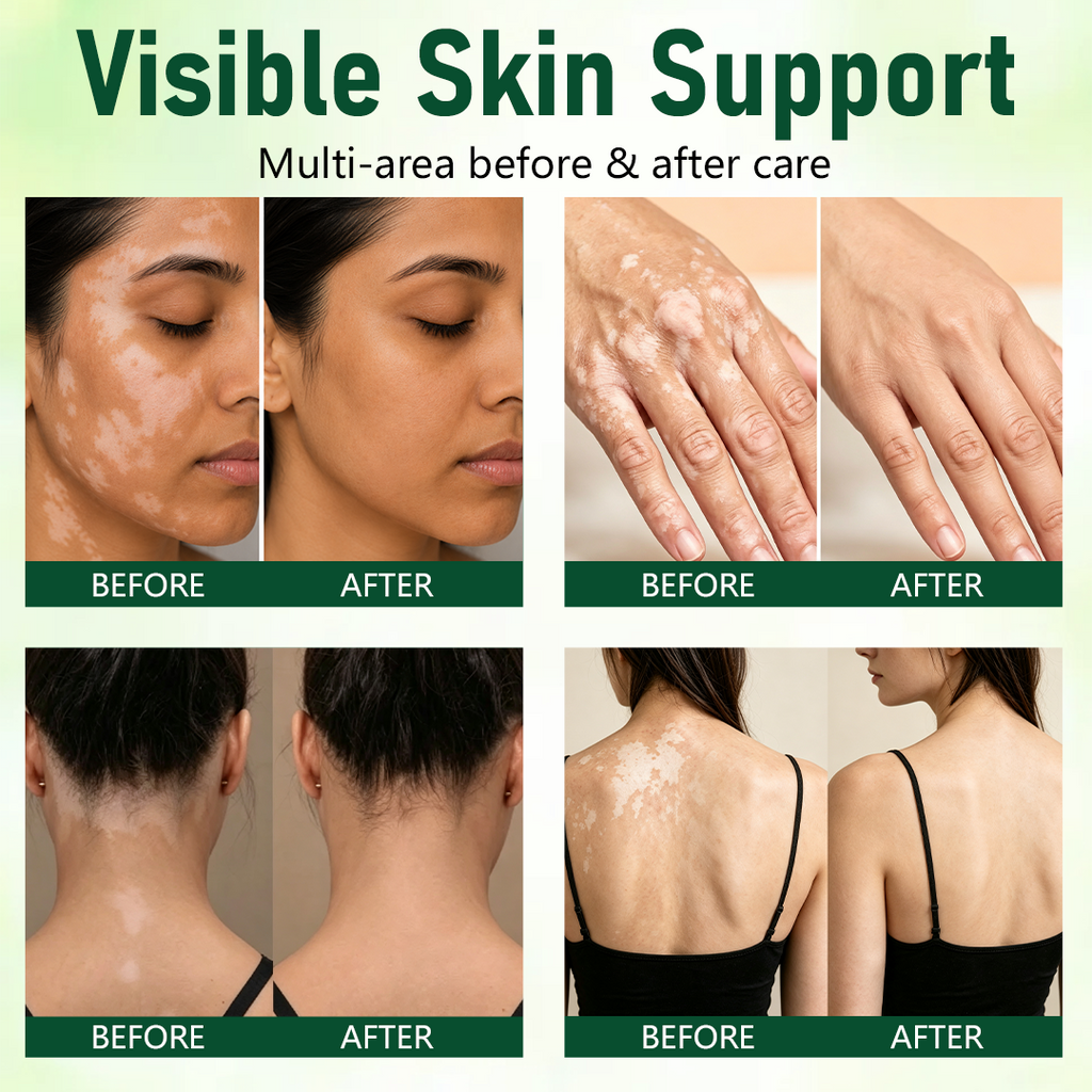 TopSpire® Herbal Vitiligo Cream