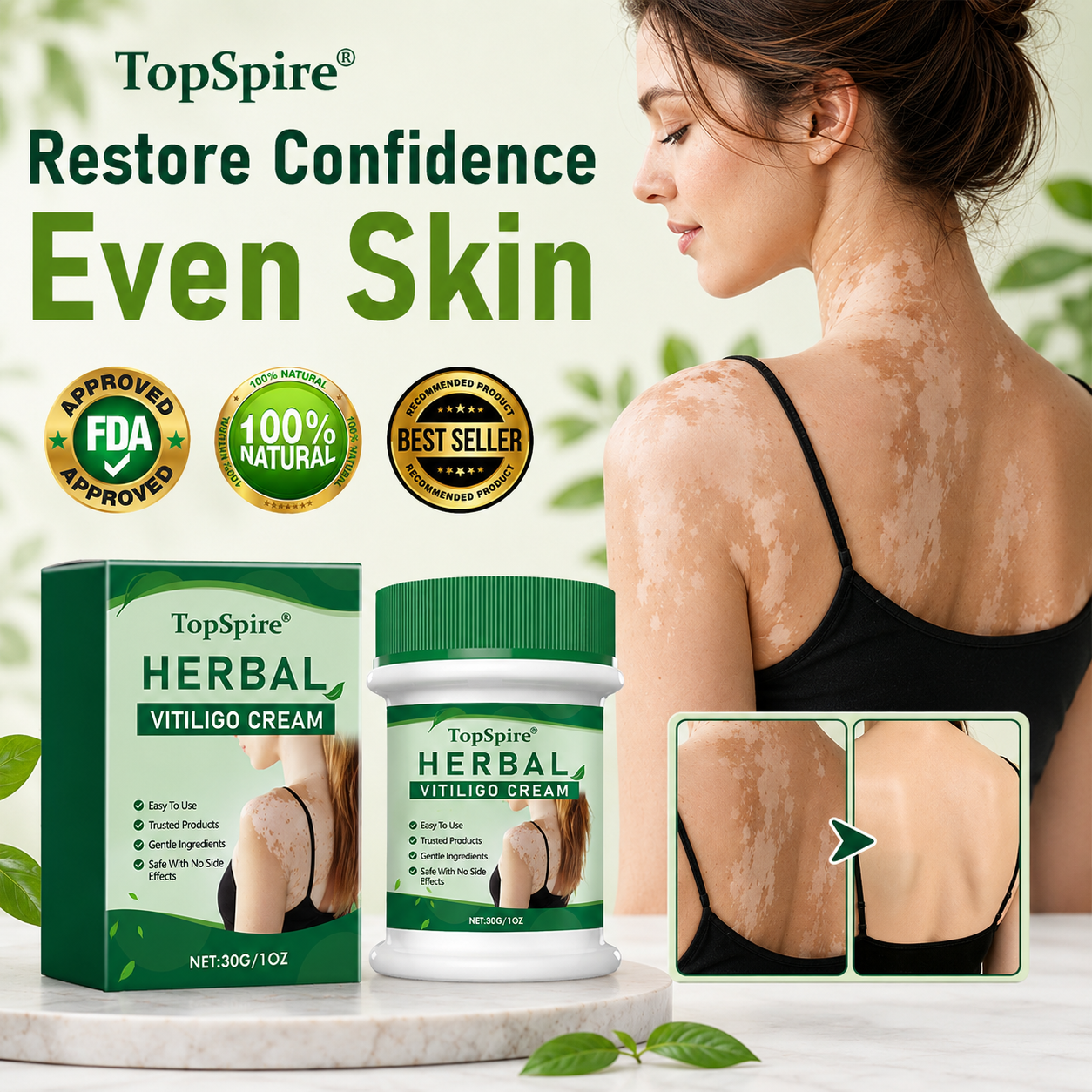 TopSpire® Herbal Vitiligo Cream
